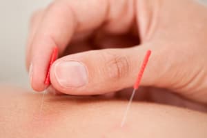 Treat infertility with acupuncture